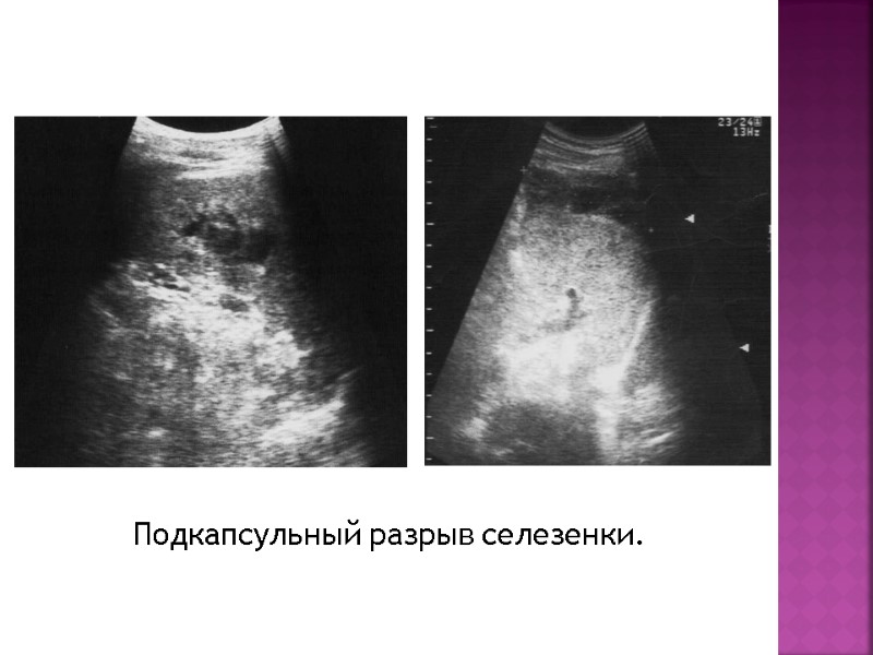 Подкапсульный разрыв селезенки.